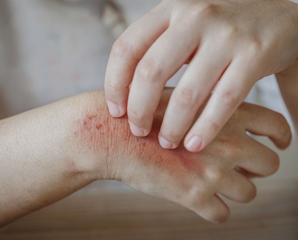 natural allergy relief case study